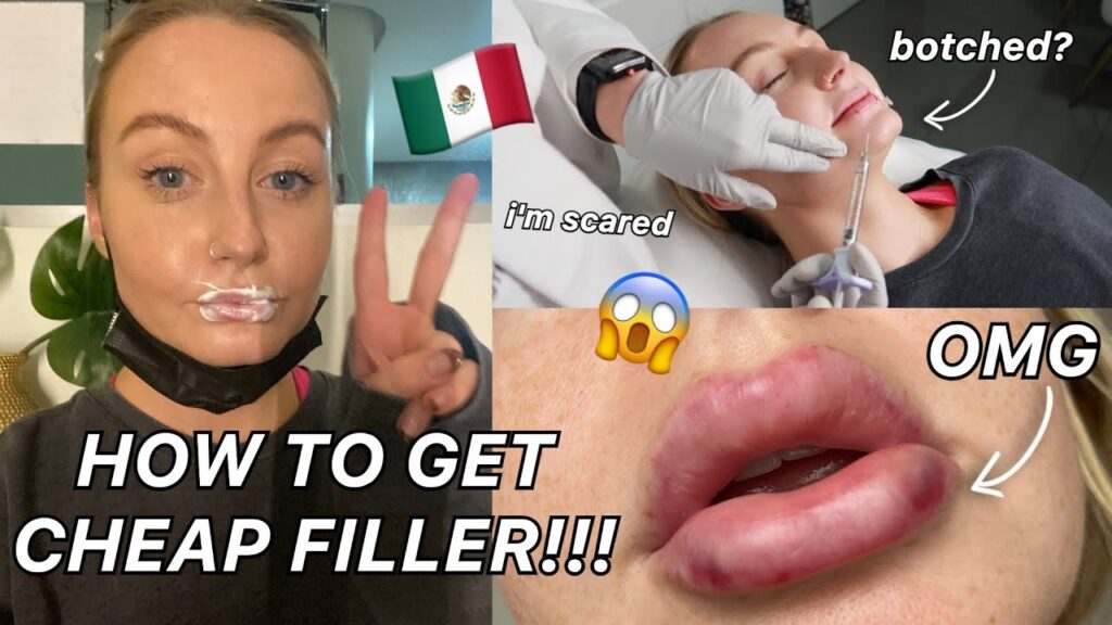 lip filler mexico city